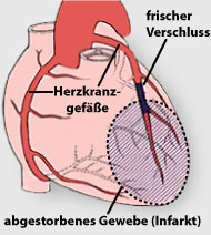 Bild Herzinfarkt der Deutschn Herzstiftung